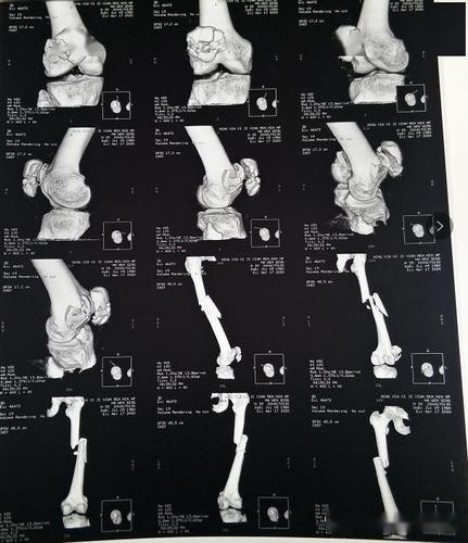 西吉县人民医院成功救治一名车祸致全身8处粉碎性骨折危重患者