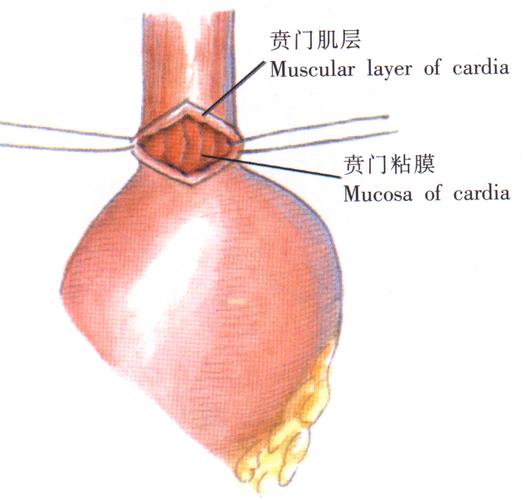 贲门肌层切开术